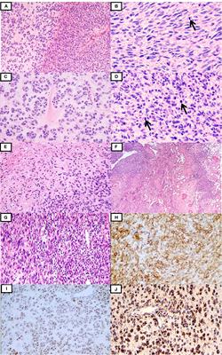 Case report: ALK-rearranged spindle and epithelioid cell neoplasms with S100 and CD34 co-expression: Additional evidence of kinase fusion–positive soft tissue tumors